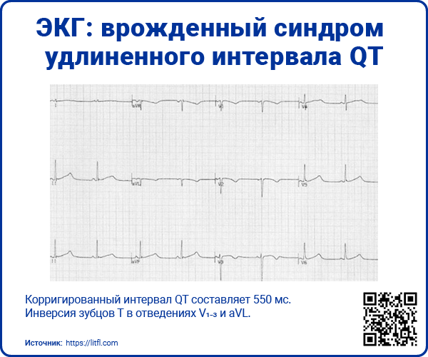 ЭКГ врожденный синдром удлиненного интервала QT